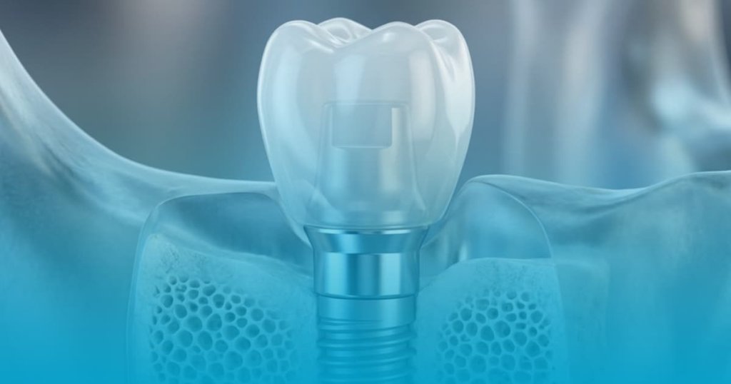 Cat rezista un implant dentar