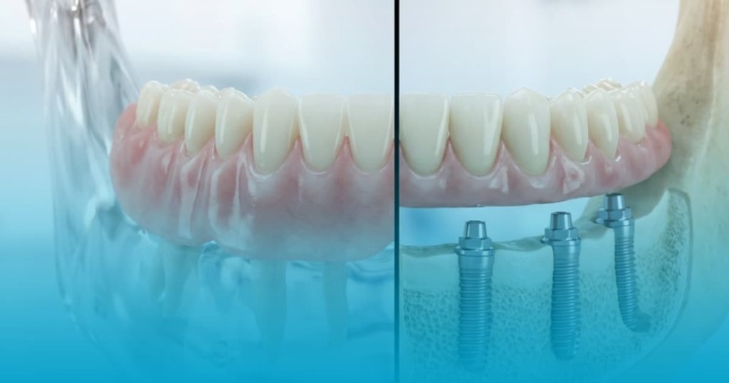 Implant vs Proteza dentara