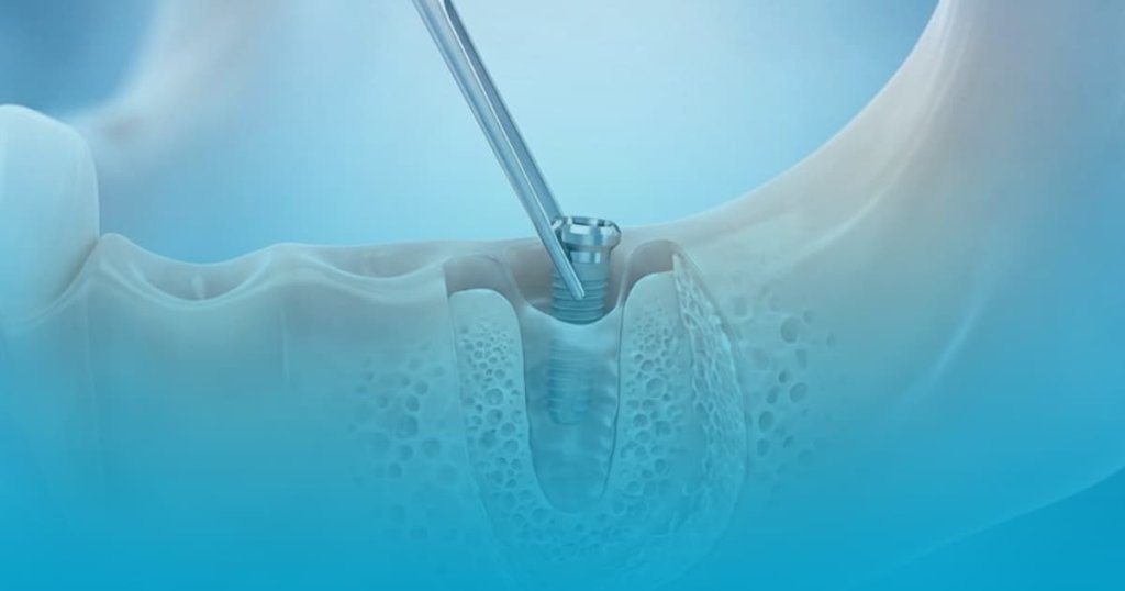 Scotere implant dentar