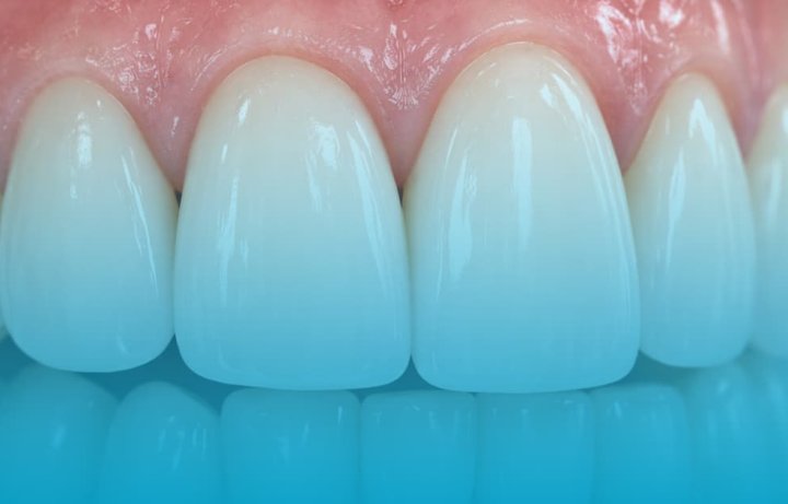 cat dureaza fatetele dentare