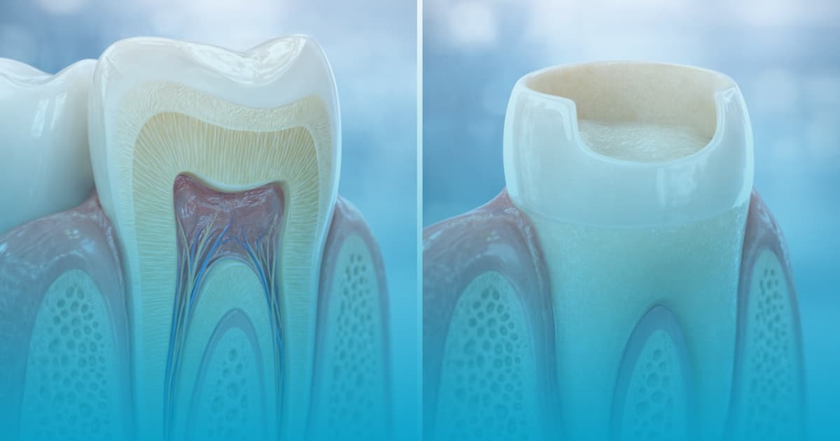 coroane dentare sau fatete