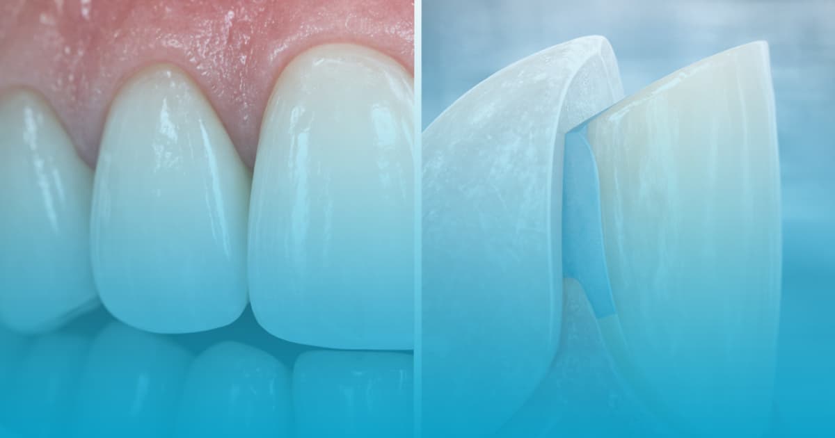 Dezavantaje fatete dentare: Ce trebuie sa stii la Select Dental Clinic 20 dezavantaje fatete dentare