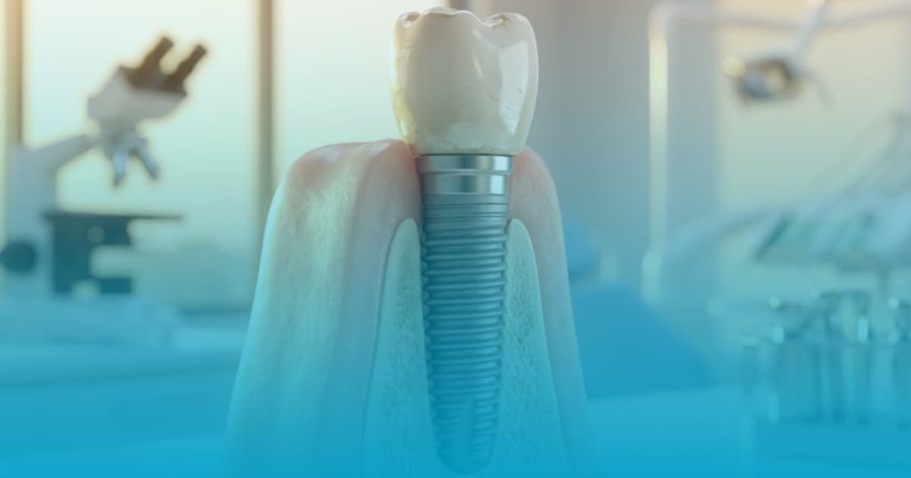 durata de viata a unui implant dentar