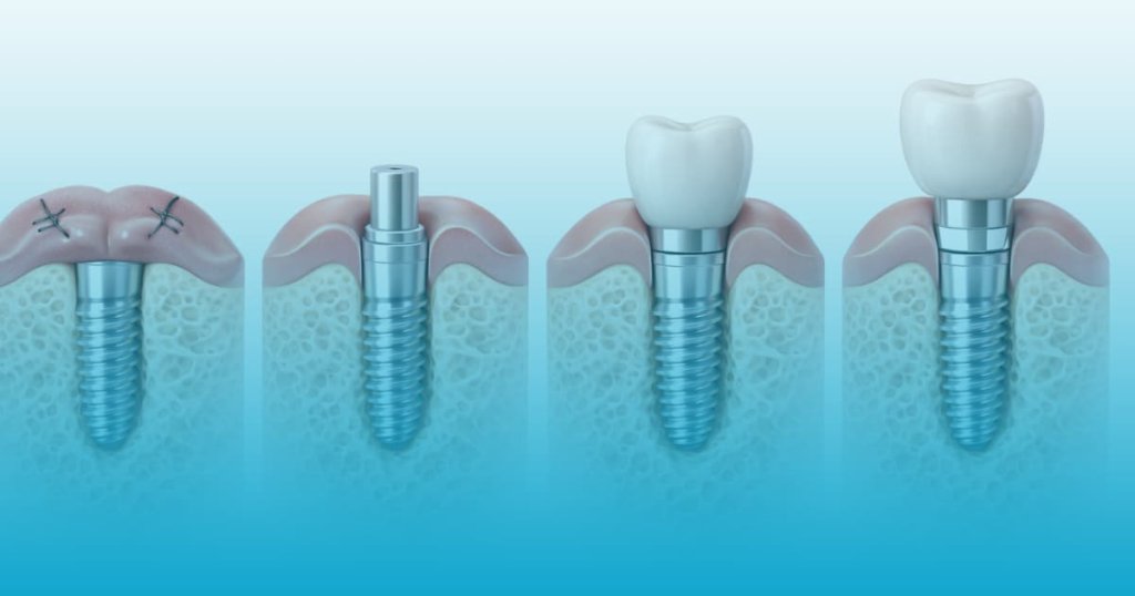 durere dupa implant