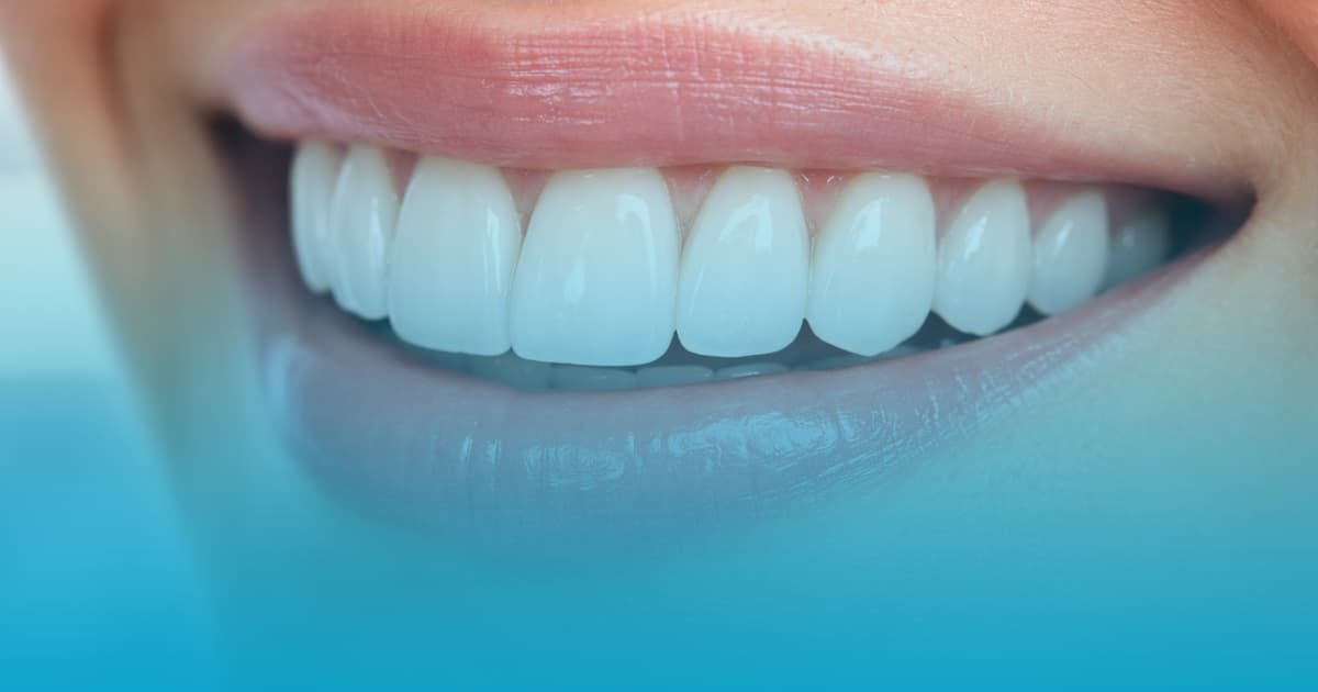 Avantaje fatete dentare: Zambet de Hollywood la Select Dental Clinic 18 fatete dentare avantaje