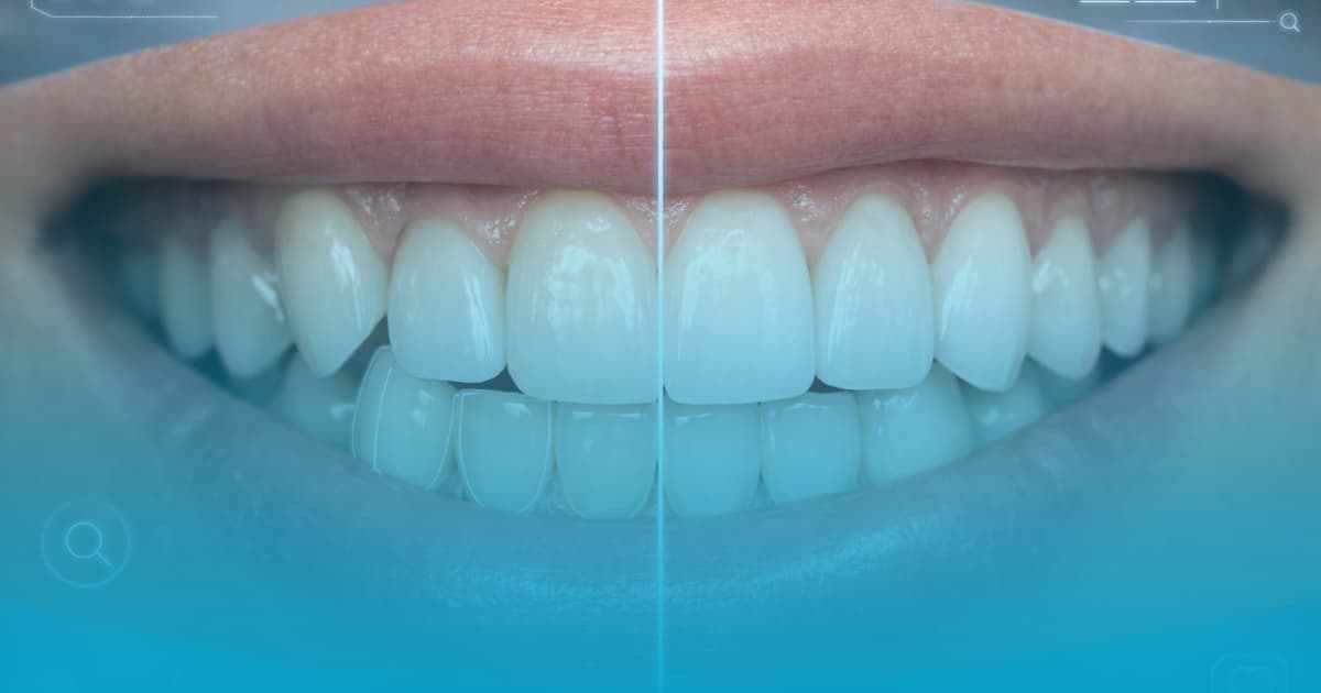 Fatete dentare pentru dinti strambi: Ortodontie rapida la Select Dental Clinic 10 fatete dentare pentru dinti strambi