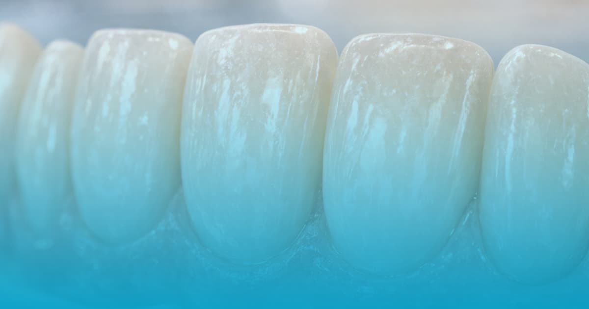 Fatete dentare portelan Bucuresti: Eleganta la Select Dental Clinic 14 fatete dentare portelan
