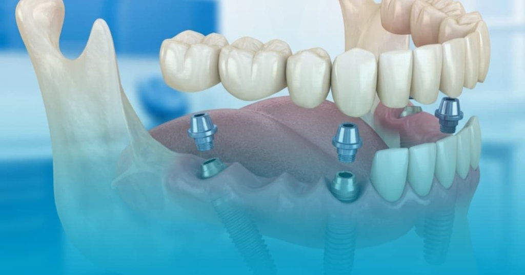 implant dentar all on 4