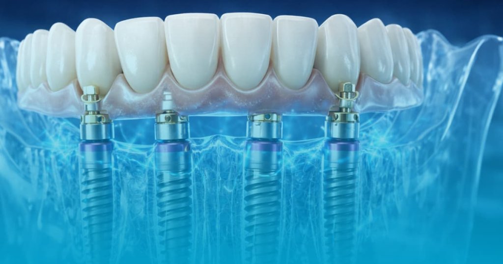 implant dentar bredent