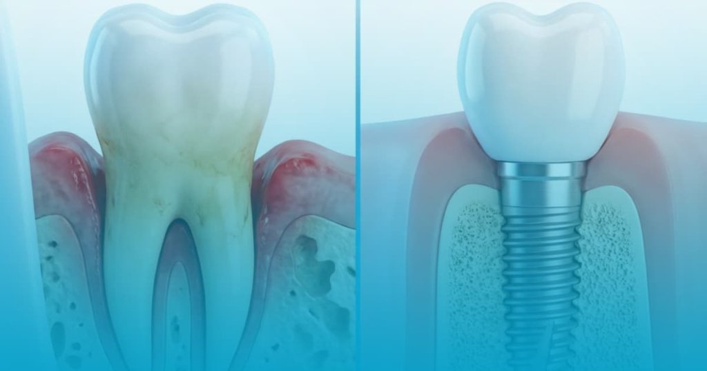 implant dentar parodontoza