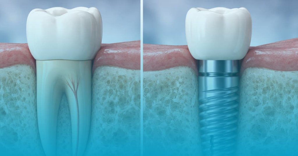 implant dentar vs coroana
