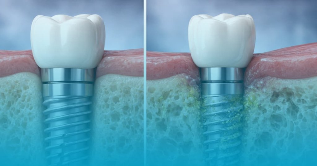 simptome respingere implant dentar