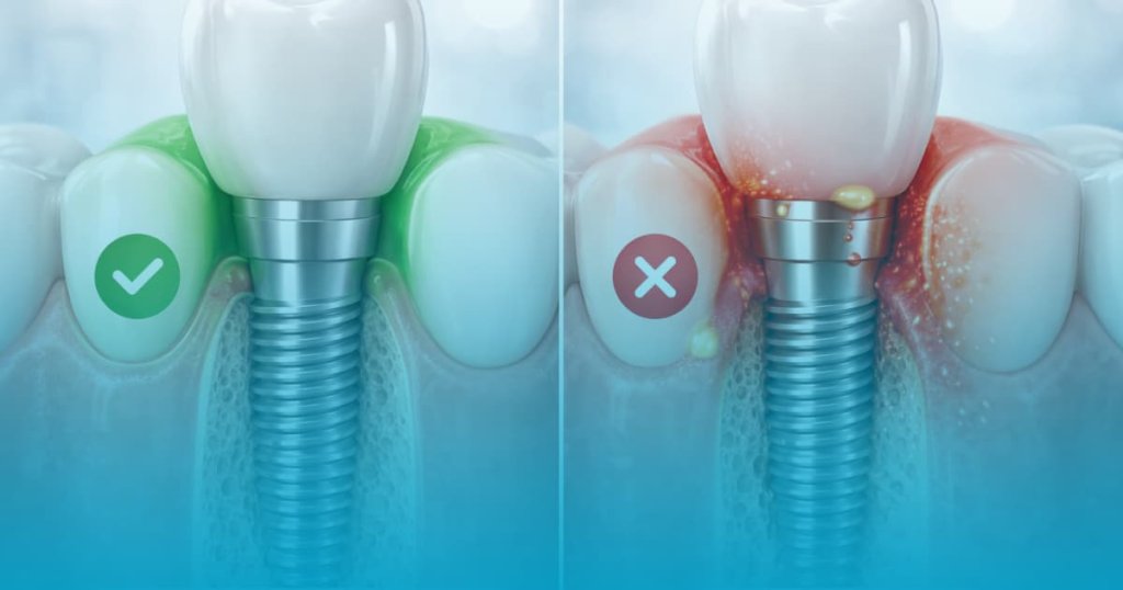 simptome respingere implant dentar img