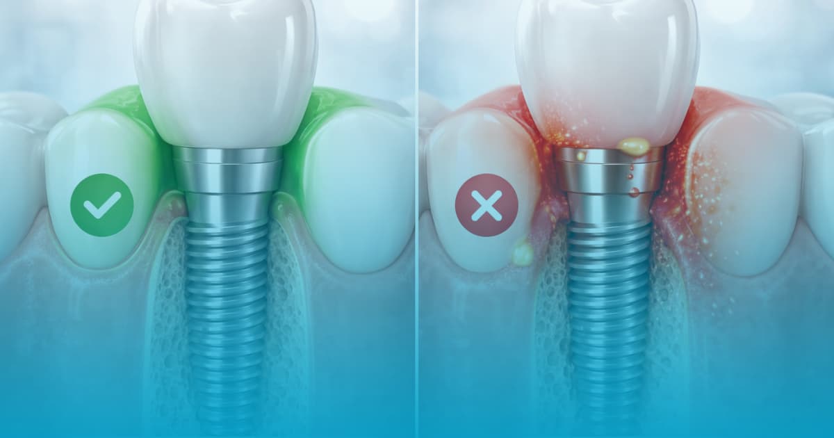 simptome respingere implant dentar img